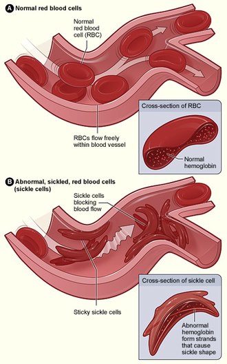 Sickle cell anemia